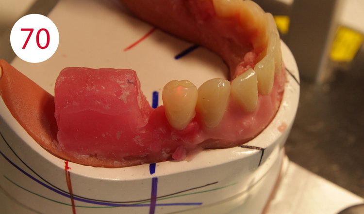 Aperçu Macro De La Bouche Ouverte Des Dents De La Langue Et Des Appareils  Dentaires En